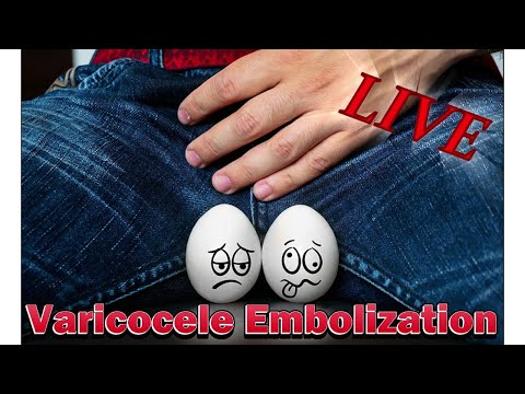 Live Patient Varicocele Embolization: A Must-See Procedure! | Dr. Pushan Sharma