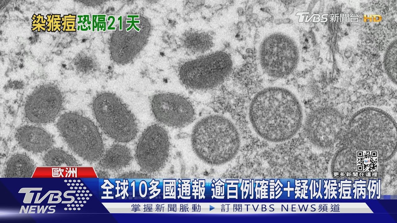 英國出現猴痘「人傳人」 莊人祥:密切關注