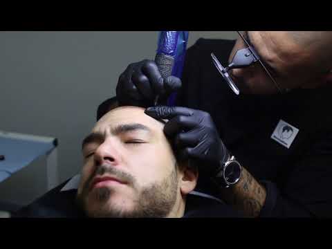 Mathieu' life changing transformation with scalp micropigmentation | Clinique MicroCapillaire