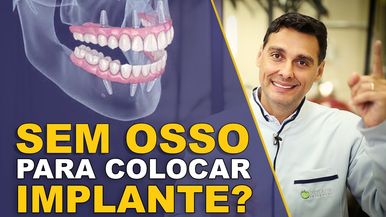 Sem Dentes na Parte Debaixo? Veja Como Recuperar Com Implantes e Sem Enxerto