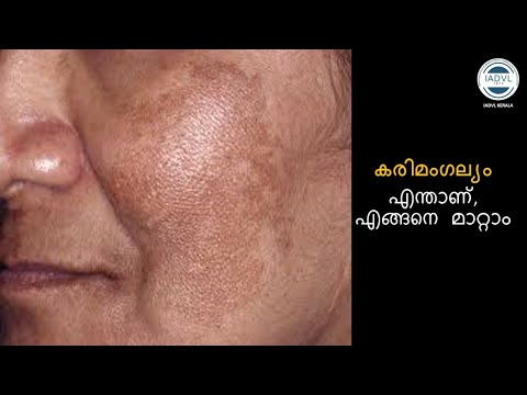 IADVL Kerala ചർമ്മാരോഗ്യം - Melasma