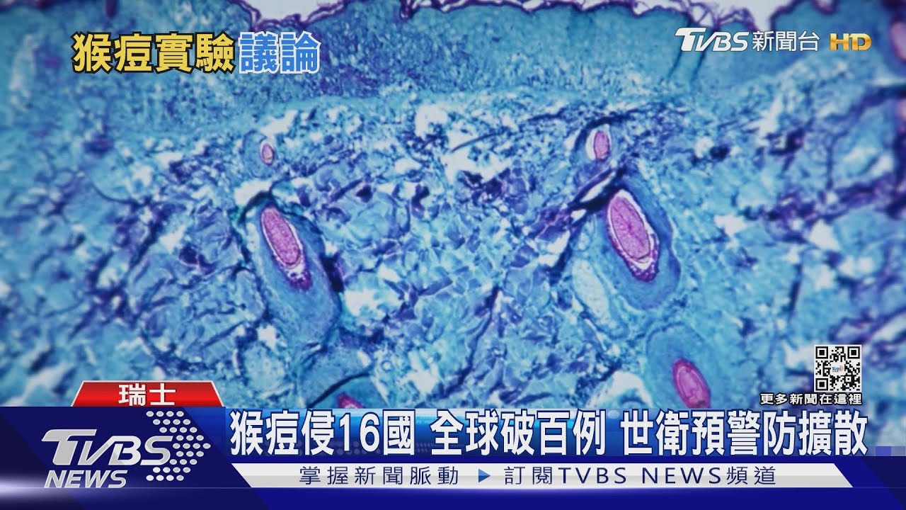猴痘侵16國!全球破百例 世衛預警防擴散