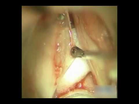 Microflap Excision of Vocal Fold Polyp