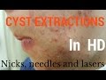 Cysts, extractions, blackheads - Removal methods in HD Cysts, extractions, blackheads - Removal methods in HD
