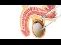 Techniques for Surgical Sperm Retrieval-Dr. Sathya Balasubramanyam of Cloudnine Hospitals