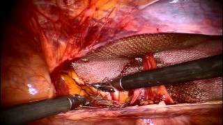 Robotic R Inguinal Hernia Repair | Ventralight ST