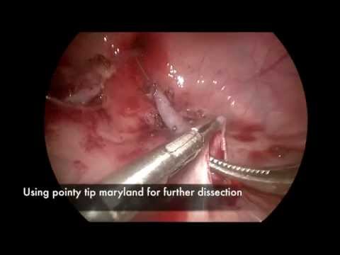 Just One Step -Tunneling in Vesicoscopic Reimplantation