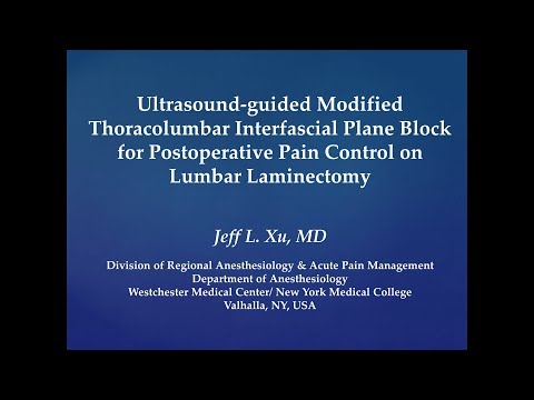 Lumbar Longissimus Plane (LLP) Block for Lumbar Laminectomy
