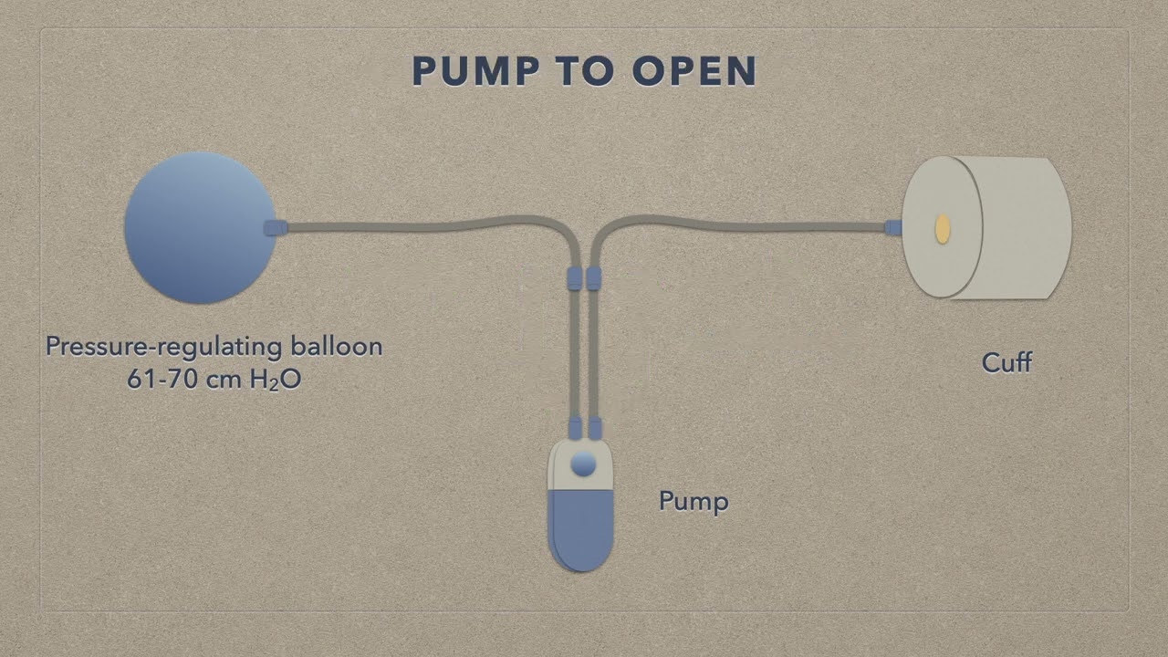 AUS (artificial urinary sphincter): How It Works