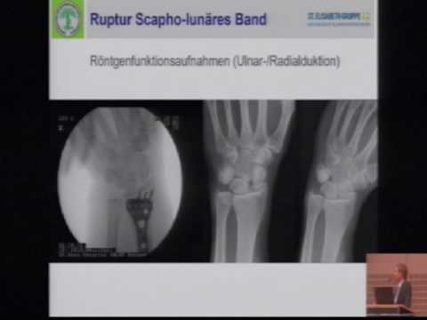 Nichtsteroidale Medikamente für Schmerzen im Rücken und Gelenke Kräutertherapie lumbalen sakrale Wirbelsäule