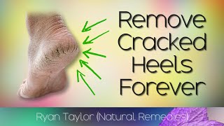 How To Remove Cracked Heels (Natural Remedies)