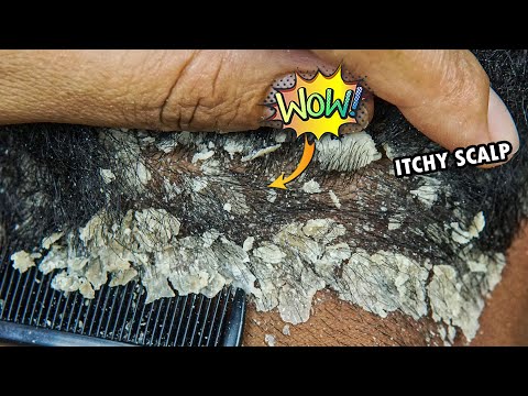 Psoriasis Scalp Scratching Big Flakes #943