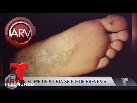 Remedios para combatir el pie de atleta | Al Rojo Vivo | Telemundo