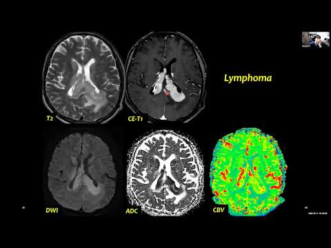 DSC, DCE and ASL for Brain Tumors Imaging (Perfusion MRI Techniques).