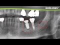 Auto Max with AnyRidge implant System