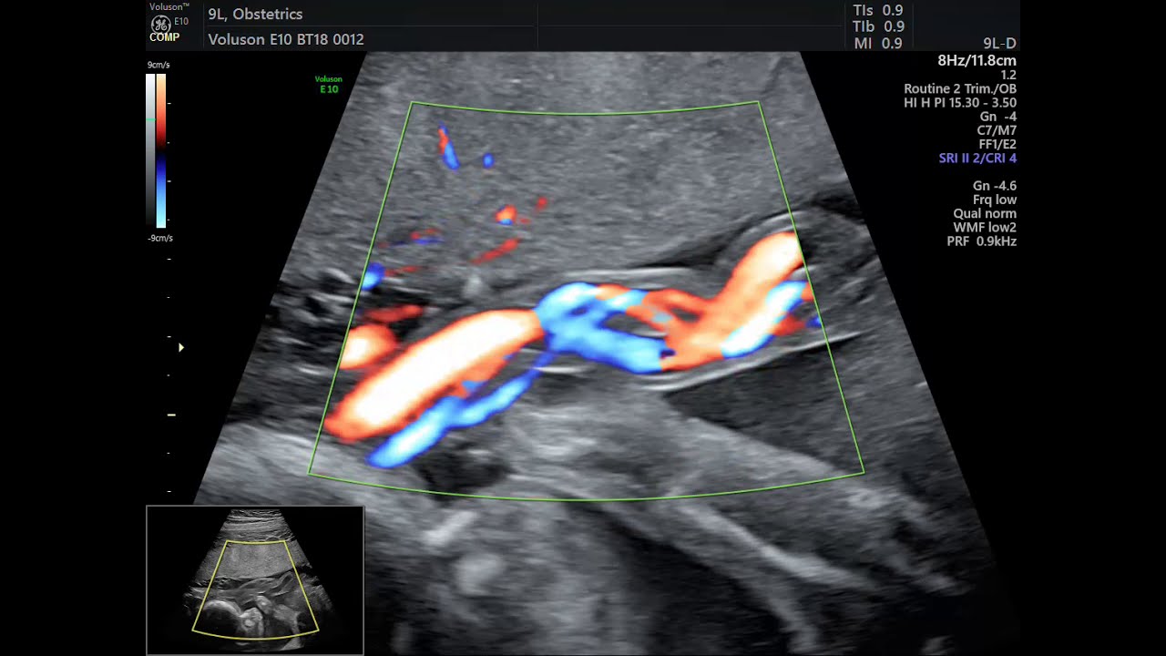 AVALIAÇÃO DE CORDÃO UMBILICAL COM DOPPLER COLORIDO