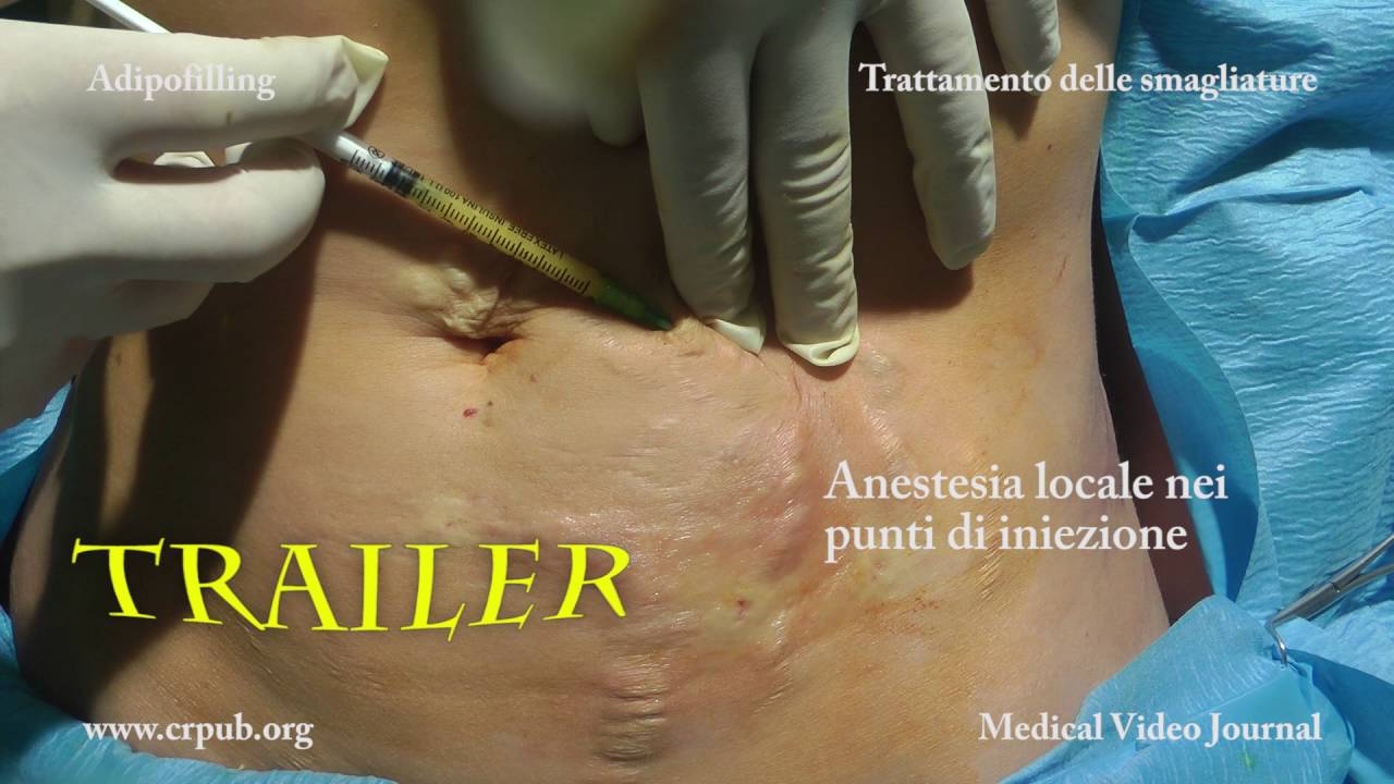 03. Trattamento delle smagliature con l’Adipofilling