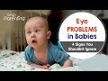 Common Eye Problems in Babies - Causes Symptoms and Treatment