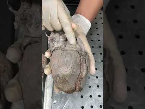 Anatomía del corazón (drenaje venoso)