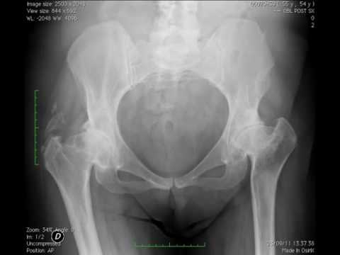 Rigidità articolare e dei piedi che A quanto ammontano le articolazioni del ginocchio