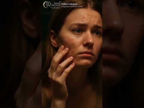 Acne Scars Treatment  | Can Acne Scars Be Removed? | Dermatologist | Cosmo Radiance Hyderabad
