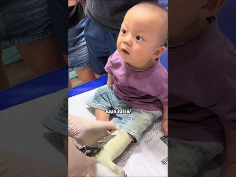Lapsi yllätti kaikki, kun hänen kipsinsä poistettiin! 😲