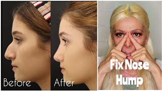 How To Get Rid Of Hook Nose & Nose Hump Naturally | Get Straight, Slim, Sharper Nose Exercises