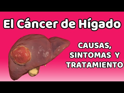 CÁNCER DE HÍGADO, Causas, signos y síntomas, diagnóstico y tratamiento