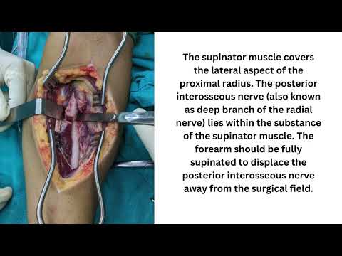Radius Plating | Henry\'s Approach | Dr Sunny Dole