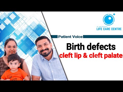 Birth defects - cleft lip & cleft palate