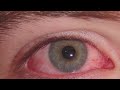 ¿Qué es, cuáles son sus síntomas y cómo prevenir la conjuntivitis?