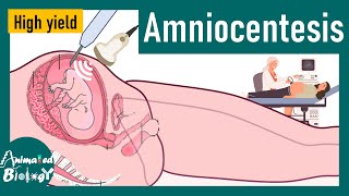 Amniocentesis | Diagnostics: Ultrasound, Chorionic Villus Sampling, Amniocentesis