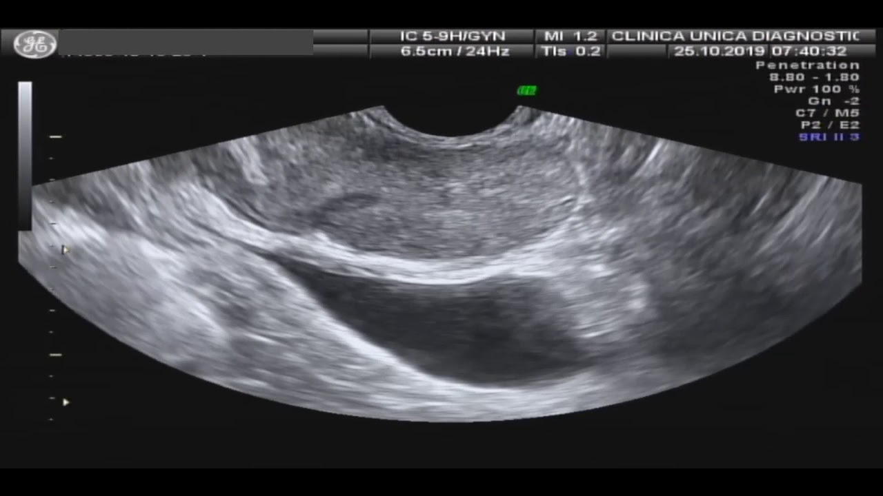 BIÓPSIA DE PRÓSTATA