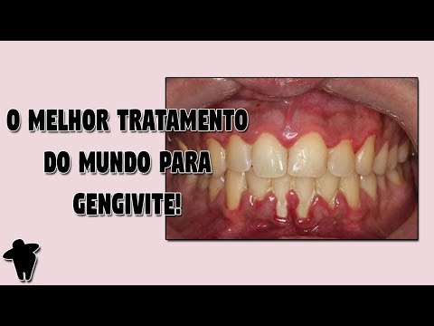 , title : 'Gengiva Inflamada e Sangrando? DESCUBRA Qual o Melhor Tratamento Caseiro DO MUNDO Para Gengivite'