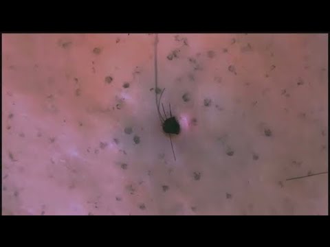 Removal of ingrown hair 