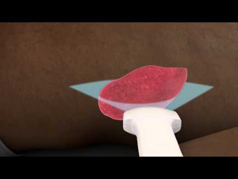 Ultrasound of the Spleen