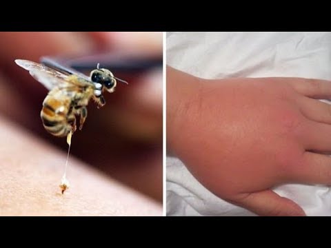 , title : '✅ Τι πρέπει να κάνουμε αμέσως εάν μας τσιμπήσει σφήκα ή μέλισσα;'