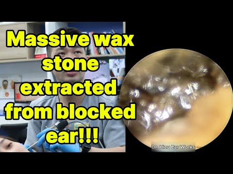 Massive wax stone extracted from blocked ear | ear cleaning | ASMR earwax | soothing |relax|