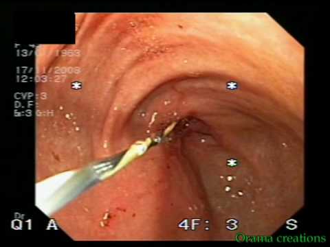Stent Implantation In Duodenal Stenosis - Cancer