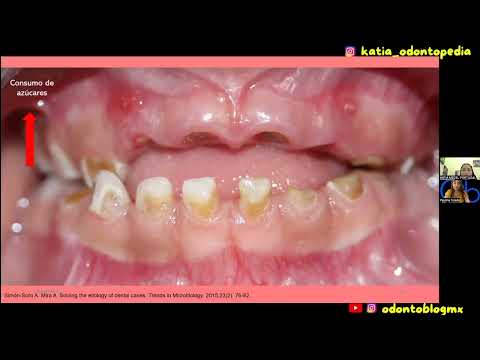 CARIES DENTAL
