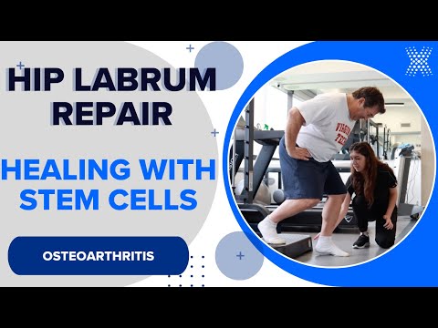 Torn Hip Labrum Recovery: A Patient’s Journey with Stem Cells
