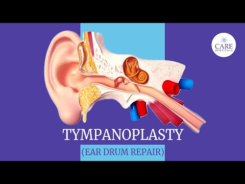 Eardrum Hole Repair Tympanoplasty | How it is done? | After Tympanoplasty  Care | CARE Hospitals