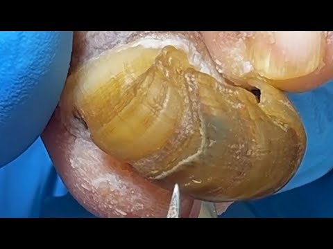 Long And Curly Toenails, Remove The Shell!【Podiatry Clinic】