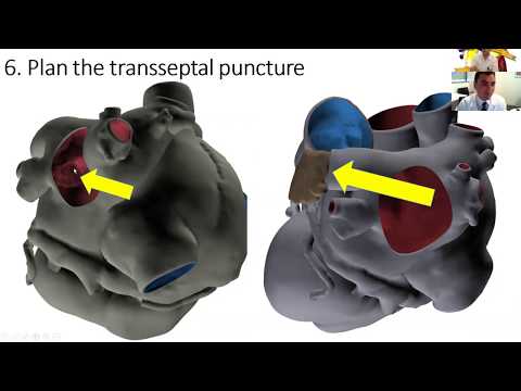 Imaging of Left atrial appendage closure/exclusion