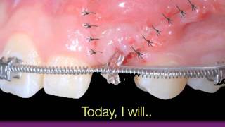 Amazing  Upper Impacted Teeth -1