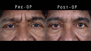 Entropion Correction Tarsal Wedge Resection