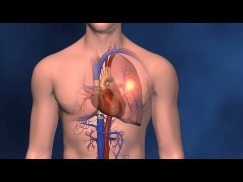 3D Medical Animation of DVT & Pulmonary Embolism