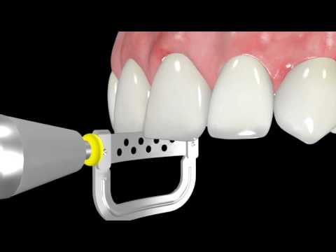 oscident IPR instruction "Strips" manually use