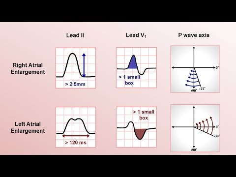 Intro to EKG Interpretation - Chamber Enlargement