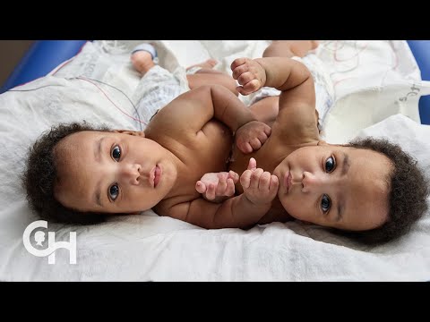 Separation of Conjoined Twins Amari and Javar